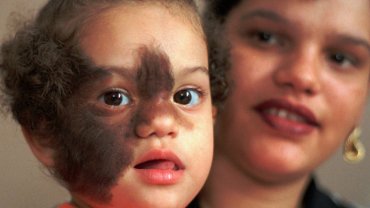 Μωρό με σύνδρομο λυκανθρώπου