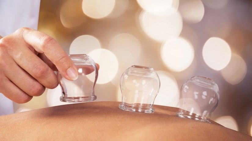 Οι βεντούζες Οι βεντούζες