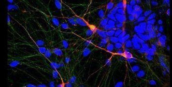 Ανακάλυψαν ουσία με την οποία πέτυχαν να θεραπεύσουν σε σημαντικό βαθμό ποντίκια που έπασχαν από το αντίστοιχο της νόσου